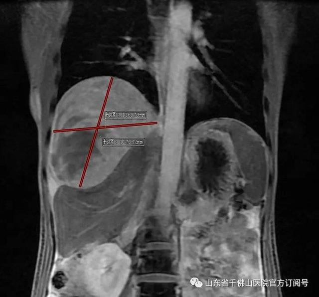 山一大一附院多学科合作切除一腹部多发巨大肿瘤