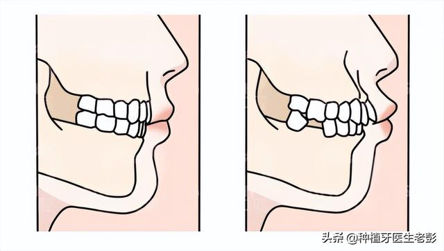 缺牙多少年还能种牙吗？哪些人适合做种植牙？