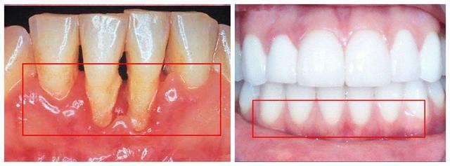 什么是牙槽骨吸收？牙骨消失牙根裸露麻烦大，及时止