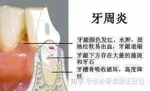 「科普」谣言粉碎机：整牙出现“黑三角”？