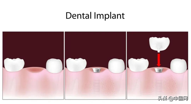 看牙好贵！为什么更多人偏爱进口种植牙？