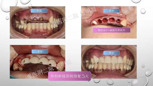 聚焦•宽仁前沿｜第30期，门牙缺失怎么办？精准保存1mm根壁即刻种植当天用