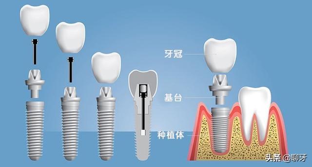 什么是种植牙？来看看做种植牙的全过程，记得平时要好好保护牙齿