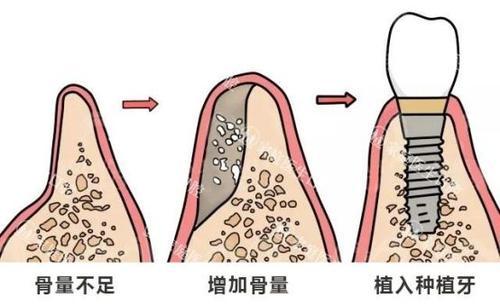 什么是植骨？有些人做种植牙为什么要植骨？