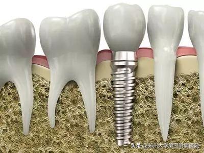 种植专家董素阁：带你全面了解种植牙