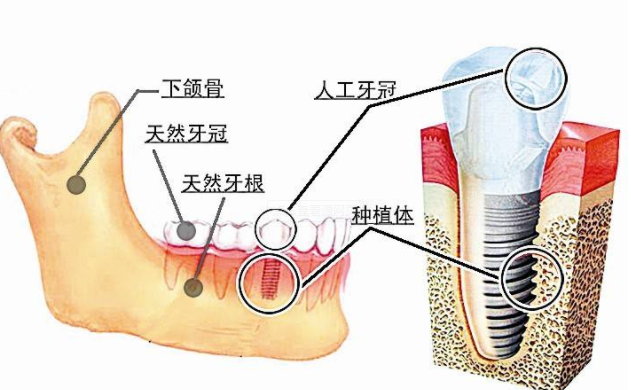 种植牙后，种进去的牙根牢固吗？会不会松动？