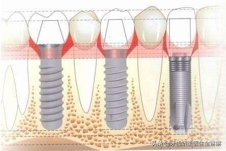 医生告诉你如何选择适合自己的种植牙