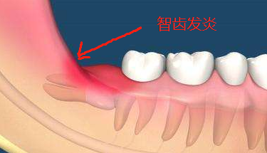 为什么智齿容易发炎？发炎引起的牙痛难忍要拔掉吗？