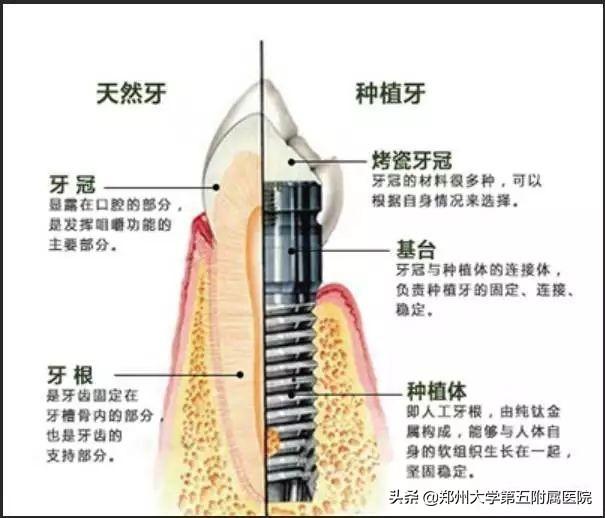 种植专家董素阁：带你全面了解种植牙