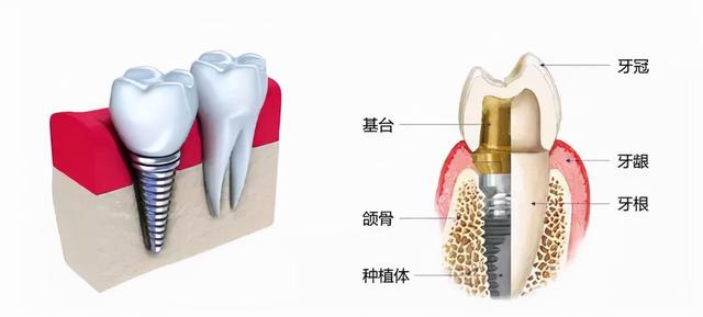 「牙齿那些事儿」No.17丨种植牙与天然牙的咀嚼功能一样吗？