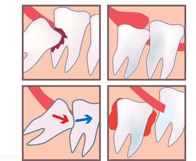 为什么智齿容易发炎？发炎引起的牙痛难忍要拔掉吗？