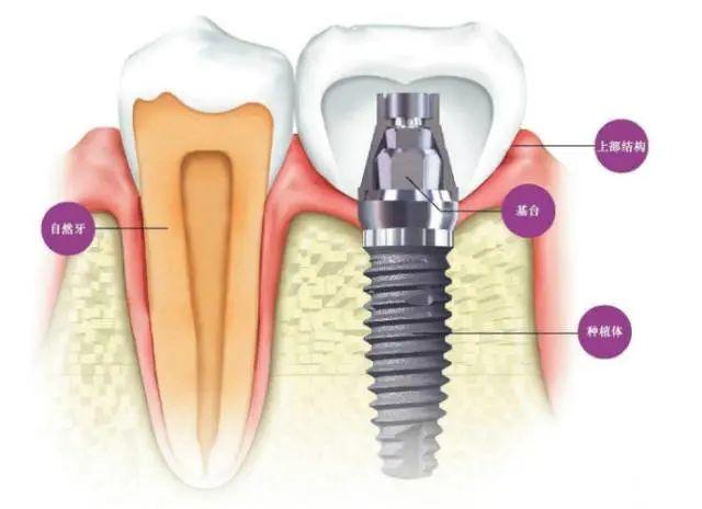 种全口牙相当于县城买套房？3分钟带你明白种植牙全过程