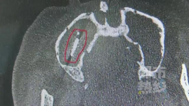 咋回事？一男子种植牙竟然“跑”到脸上？医生30分钟手术取出