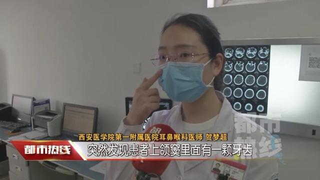 咋回事？一男子种植牙竟然“跑”到脸上？医生30分钟手术取出