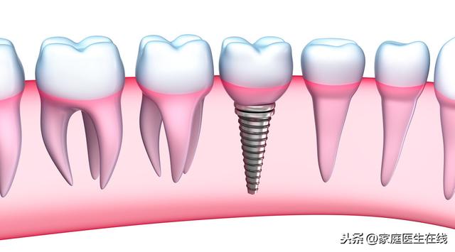 种植牙后能不能做核磁共振？主要是看这个原因，很多人都不清楚