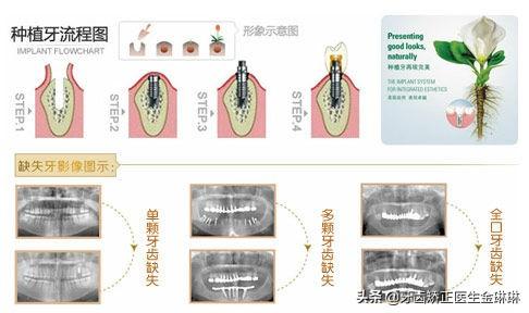 医生告诉你如何选择适合自己的种植牙