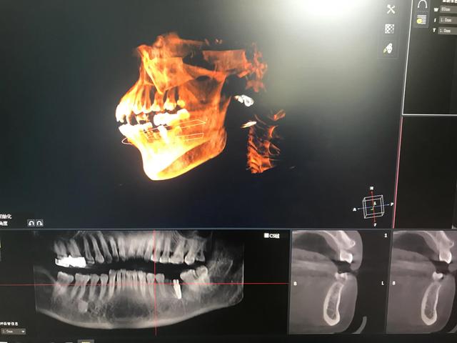 种植牙案例28