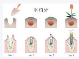 上了年纪想种牙，怎样才能又快又好？