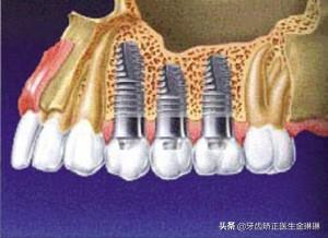 医生告诉你如何选择适合自己的种植牙