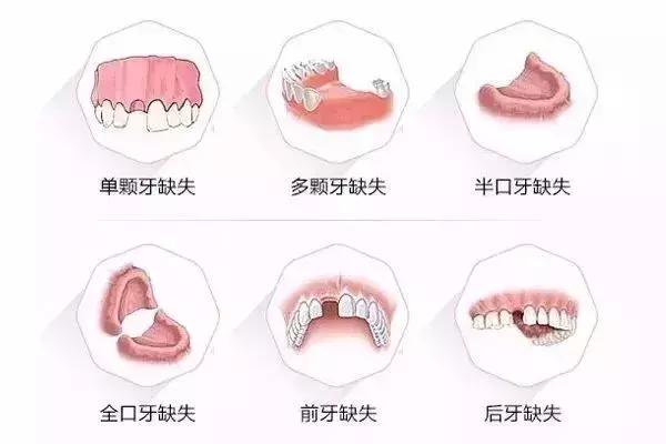 贝壳口腔「你种牙，我返全款」活动圆满落幕