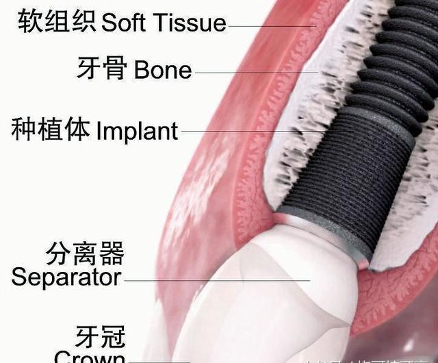 进口种植牙与国产种植牙有什么区别？