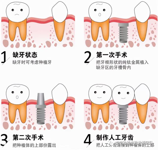 种植牙，种完就没事了？错！日常维护很重要