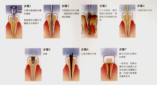 种牙好还是根管治疗好？