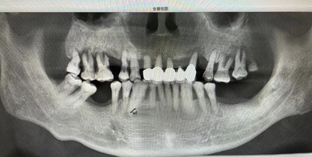 【病例分享】数字化导板精准种植和即刻负重