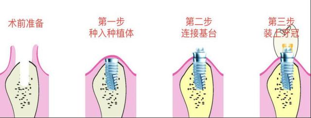 深圳种植牙降价多少？中山七院专家解答种植牙热点问题