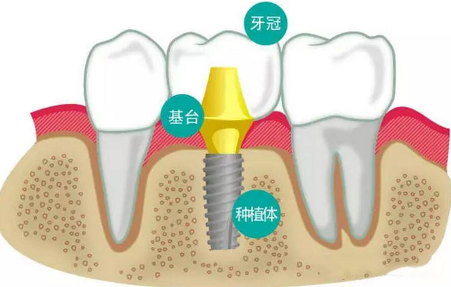 种植牙真的比镶牙更好吗？