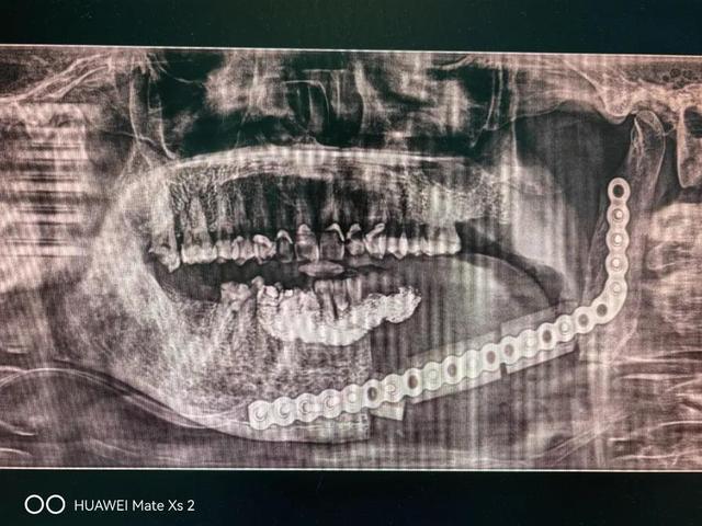 3D打印，滨州市人民医院口腔颌面外科助患者颌骨重建