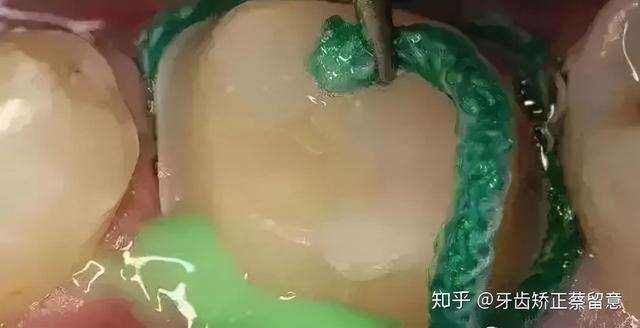 郑州牙套记录：瓷牙冠边缘不密与咬合高的原因