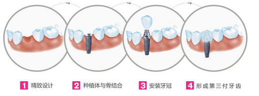 假牙 VS 种植牙，谁更好？终于懂了