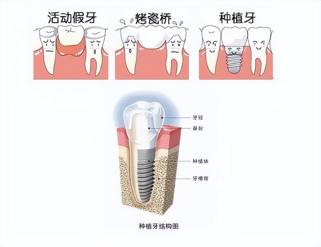 【名医名院】关于种植牙，你想知道的都在这里