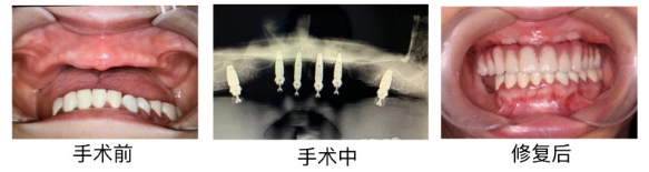 这些种植牙背后的真相，可能没人会主动告诉你！