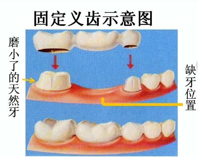 常见的假牙修复方式有哪几种？哪种最好？