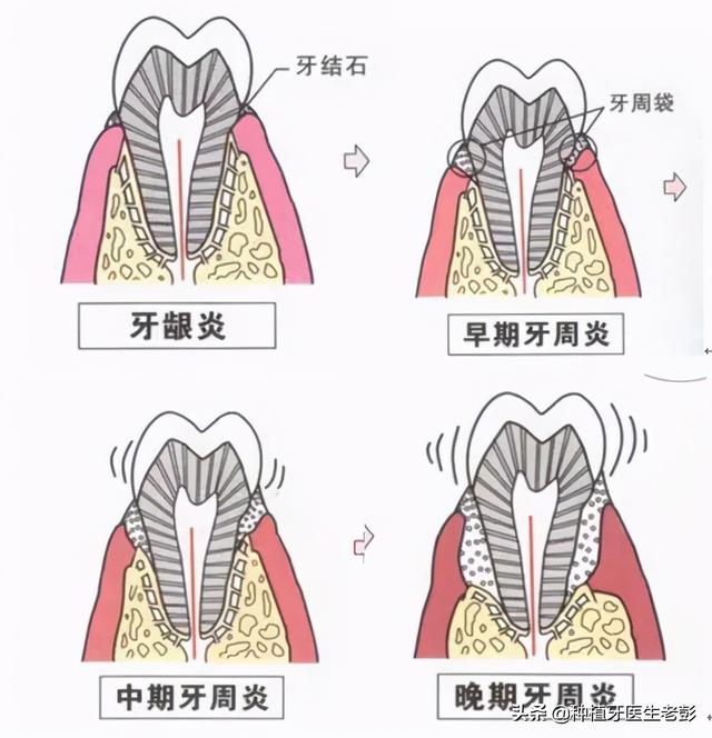 今年45岁，已经缺牙20年了，还能种牙吗？