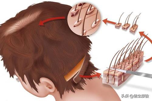 微针植发是提取毛囊吗？