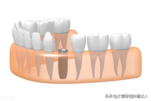 要种牙了，这些注意事项一定要看