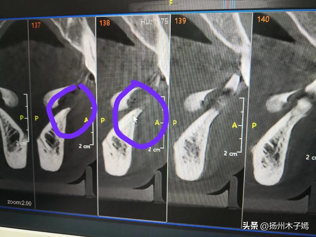 陪爸爸在仪征看牙——种植牙