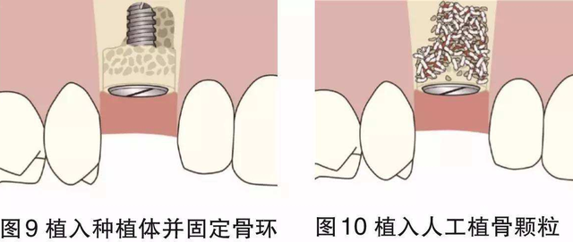 牙齿缺失危害大，想种牙为何医生却让我先植骨？听听看牙医怎么说