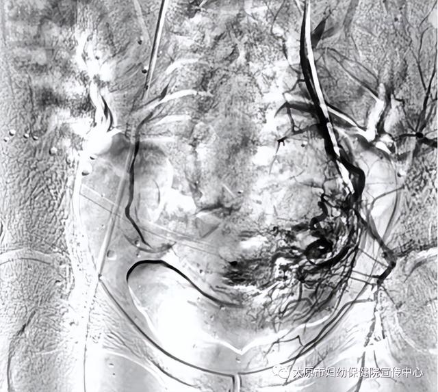 有一种危险叫剖宫产瘢痕妊娠！太原市妇幼保健院顺利完成介入术