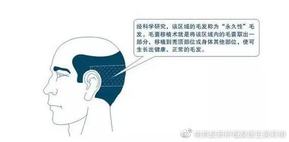 种植发际线的毛囊都是从哪儿取的？