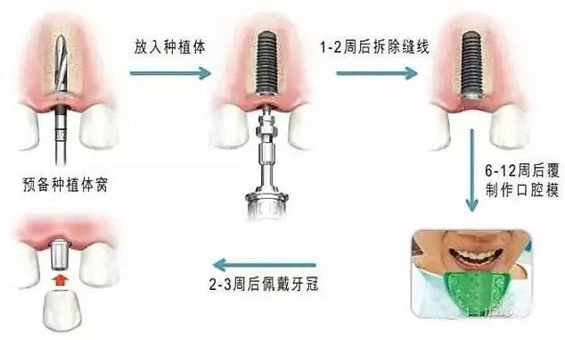 假牙、烤瓷牙、种植牙哪一个省钱？快来听听专家怎么说