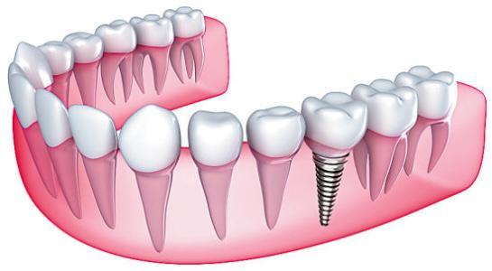 种植牙过程疼吗？钛合金材料与人体相容性高吗？听听牙医怎么说