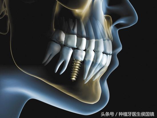 从七个方面PK，精准“即刻用”种植牙VS传统种植牙