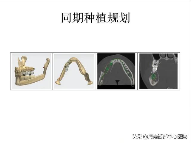 又一海南省首例！——海南西部中心医院口腔科顺利开展下颌骨肿瘤切除及腓骨皮瓣移植手术