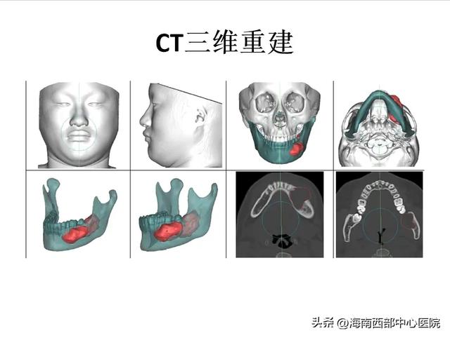 又一海南省首例！——海南西部中心医院口腔科顺利开展下颌骨肿瘤切除及腓骨皮瓣移植手术