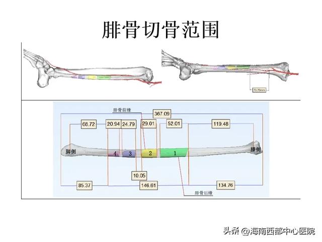 又一海南省首例！——海南西部中心医院口腔科顺利开展下颌骨肿瘤切除及腓骨皮瓣移植手术