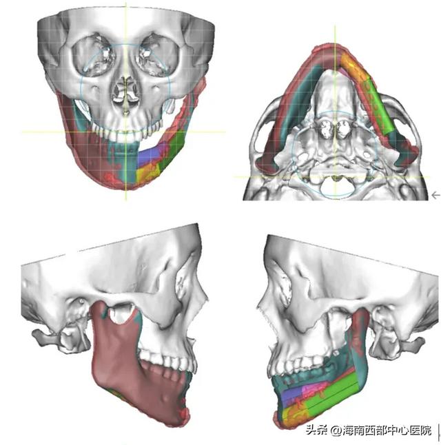 又一海南省首例！——海南西部中心医院口腔科顺利开展下颌骨肿瘤切除及腓骨皮瓣移植手术